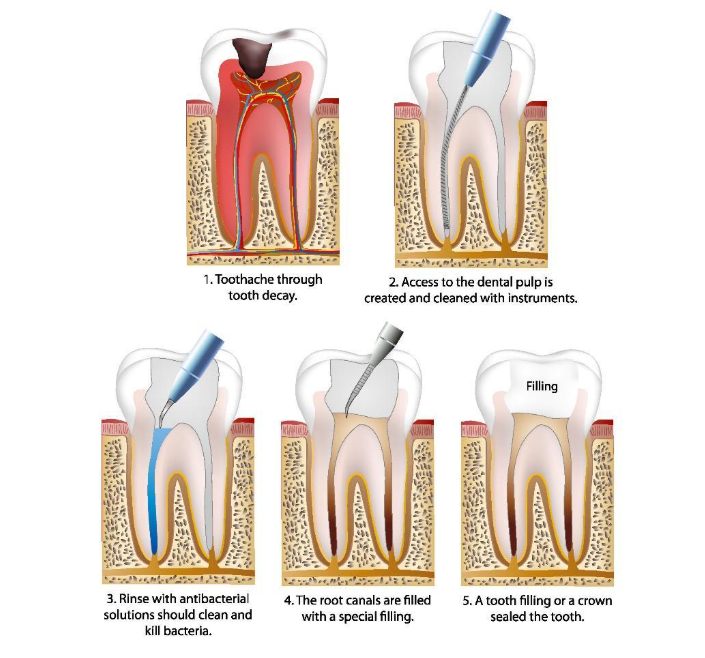 Signs You May Need a Root Canal Treatment: When Should You See a Dentist?